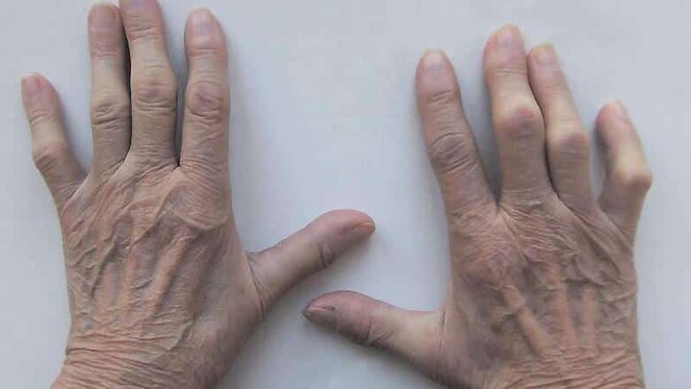 Methods to treat pain in your fingers joint