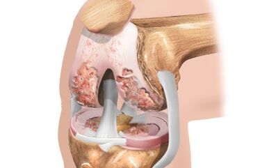 Knee wrist arthrosis