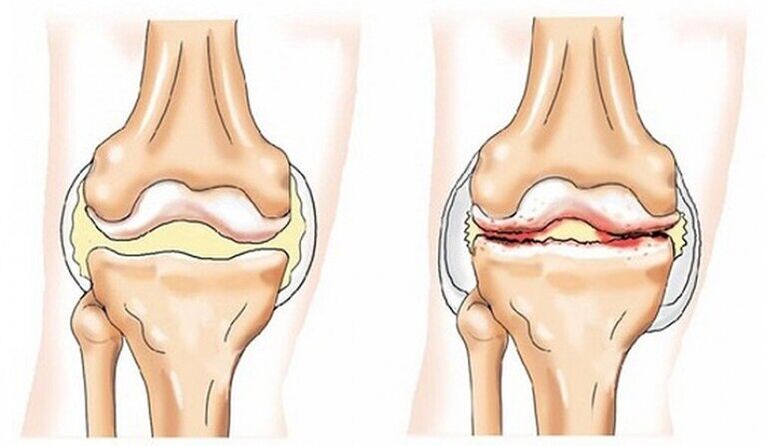 A healthy wrist and wrist affected by arthrosis