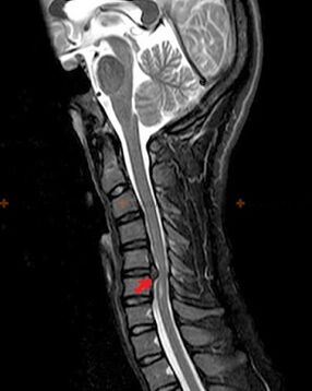 X-ray of the spine