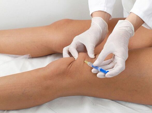 intra-articular injection for knee arthrosis