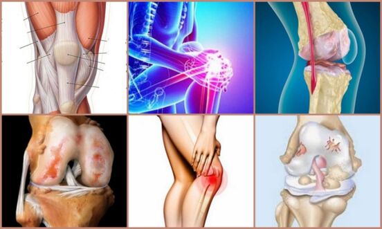 development of knee arthrosis