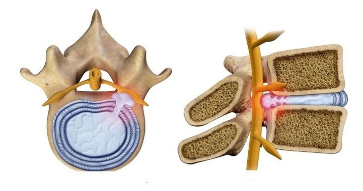 Intervertebral disc herniation – protrusion of the disc core into the spinal canal